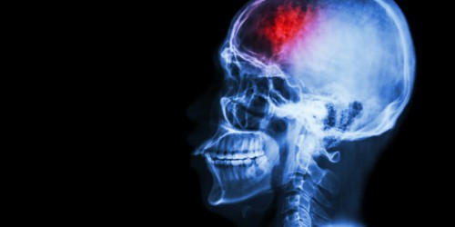 Stroke And Multiple Sclerosis: Differences And Similarities